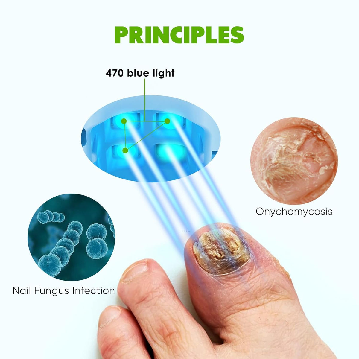 Blue Light for Nail Fungus K986899